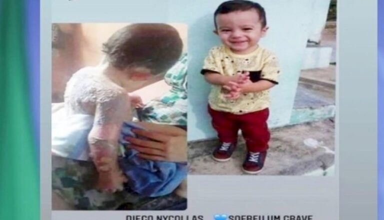 Criança de 1 ano e 8 meses tem o corpo queimado por óleo quente no Vale do Piancó