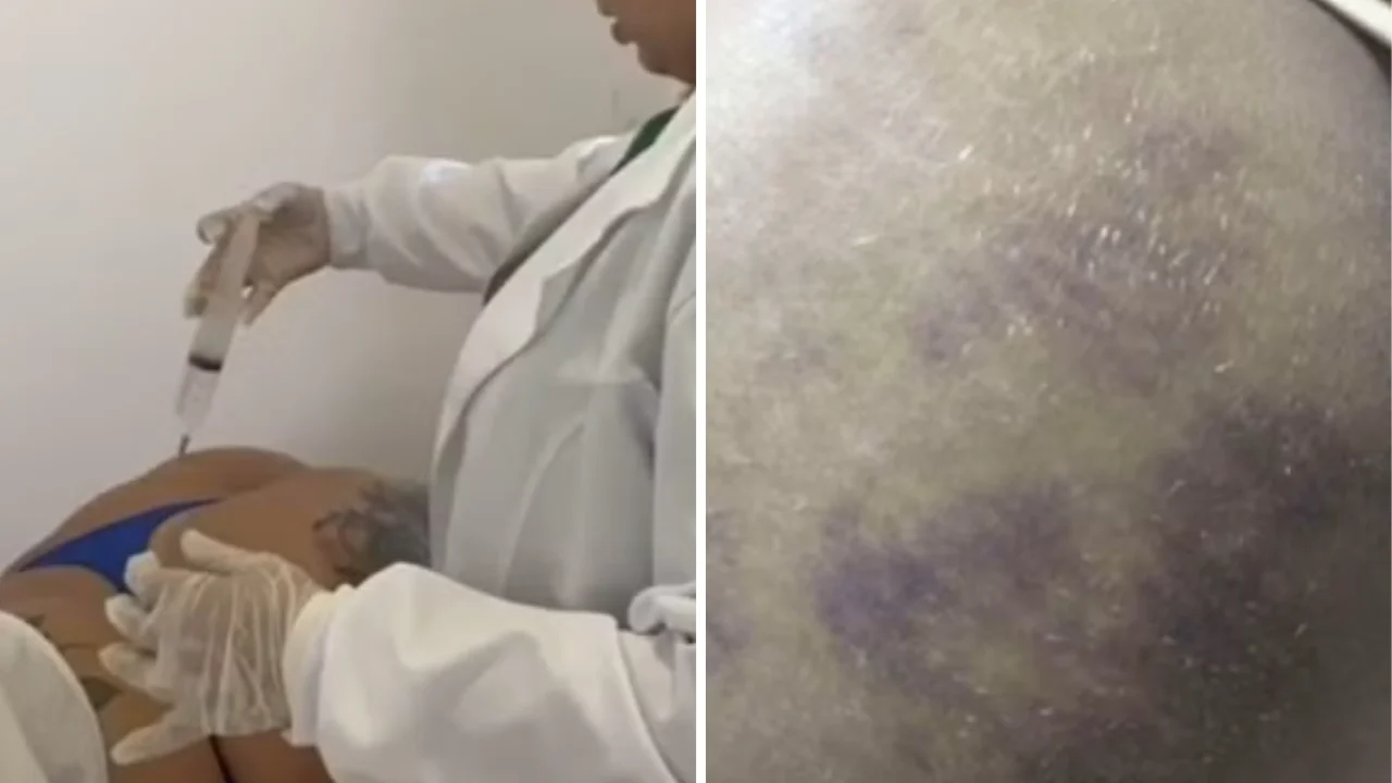 Suspeita de aplicar silicone de construção em glúteos é presa na Capital
